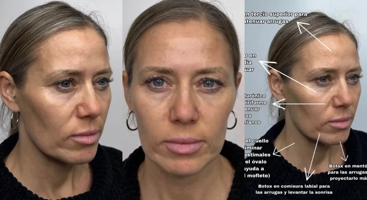 Ludmila Ksenofontova sorprendió al mostrar renovado rostro tras retoques estéticos: así quedó