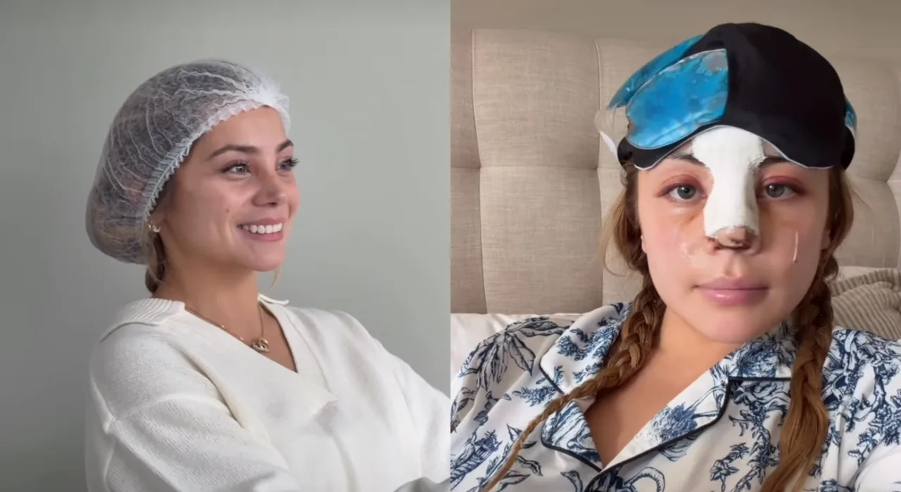 “No opine de cuerpos ajenos”: Skarleth Labra frenó las críticas tras mostrar su cirugía de nariz
